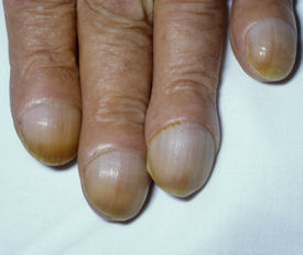 Clubbing acropachy of fingers The fingertips are bulbous with unusually curved and rounded fingernails Clubbing often occurs as a symptom of disorders associated with a decrease in oxygen levels