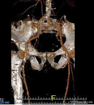 CT angiogram showing a heavily calcified obstruction in the right common femoral artery corresponding to the bruit heard on physical examination