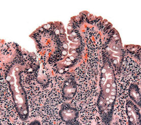 Biopsy of small bowel showing celiac disease manifested by blunting of villi crypt hyperplasia and lymphocyte infiltration of crypts consistent with Marsh classification IIIJerome Groopman FACP 