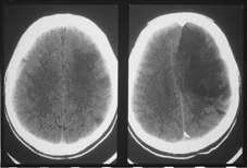 Left panel A small hypodense area in the left frontoparietal region with loss of the gray-white matter differentiation Right panel a large wedge-shaped hypodensity in the distribution of the left