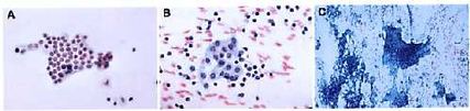 A Colloid nodule with a cluster of normal follicular cells Papanicolaou x60 B Specimen showing lymphocytes and Hurthle cells Hashimoto thyroiditis Papanicolaou x60 C Subacute granul