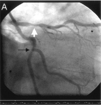 A sirolimus-eluting stent to treat proximal left anterior descending stenosis white arrow less-thanigreater-thanAnn Intern Medless-thanslashigreater-than 20051435