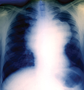 A case of non-Hodgkins lymphoma colored chest X-ray There is a swollen lymph node white mass in the center of the chest The heart white is at lower center Photo by ZephyrslashScience Source