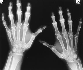 Osteoarthritis of the hands with joint space narrowing and osteophytes  American College of Physicians Photo  American College of Physicians