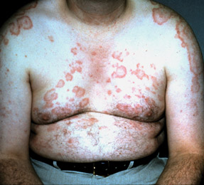 This patient has a rash in subacute cutaneous lupus erythematosus an annular polycyclic rash characterized by scaly erythematous circular plaques with central hypopigmentation Photo American