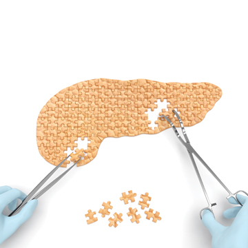 To identify patients at higher risk of developing severe pancreatitis physicians should rely upon their clinical judgment watching out for the presence of systemic inflammatory response syndrome alo