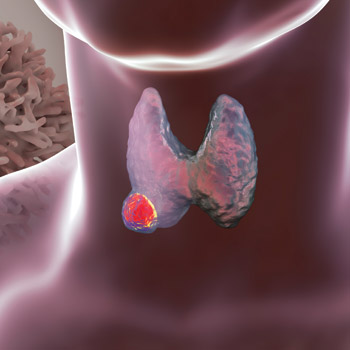 Thyroid cancer surveillance strategies and schedules need to be based on which treatment patients received as well as the time elapsed since then Image by Dr_Microbe