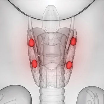 In primary hyperparathyroidism one or more of the four parathyroid glands makes too much parathyroid hormone which causes excess levels of calcium in the blood and can predispose patients to loss of