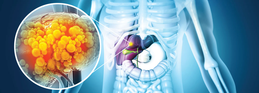 Patients with cirrhosis due to metabolic dysfunction-associated steatotic liver disease hepatitis C or alcohol use make up about 80percent of patients waiting for a liver transplant Image by Crystal light